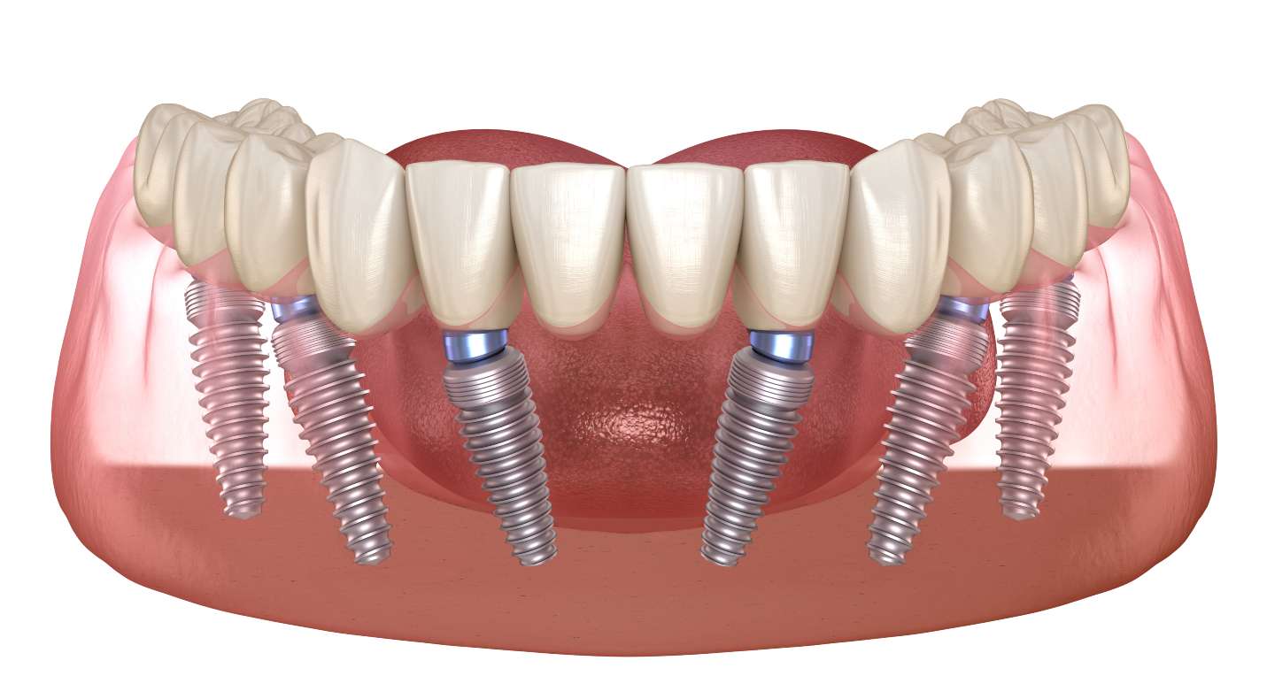 all on 6 implants harlow